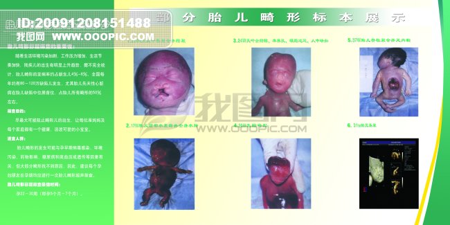胎儿彩超筛查部分胎儿畸形标本展示模板下载(
